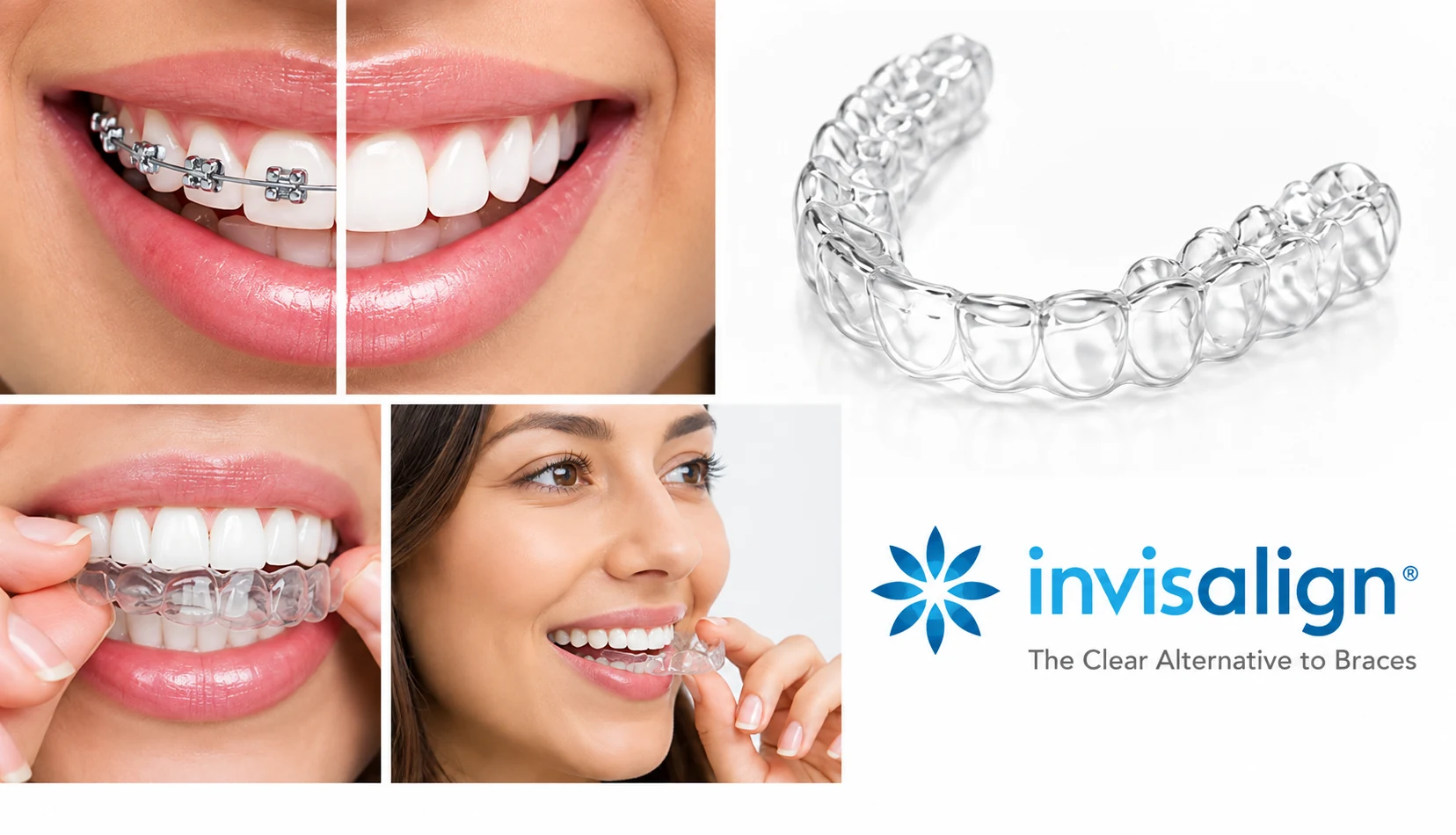 Invisalign clear aligners shown beside traditional metal braces