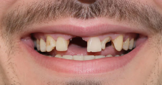 Are you a candidate for a full mouth restoration?