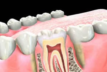 Do You Need a Root Canal Procedure?