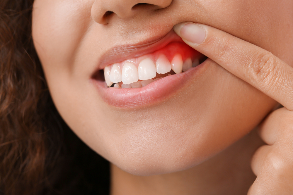 What Are the Signs and Symptoms of Gum Disease?