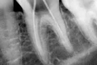 The Facts About Root Canal Therapy