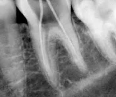 rootcanal