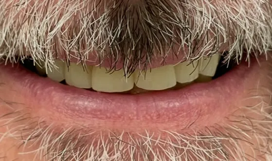 Case 1, after treatment at Merry Dental