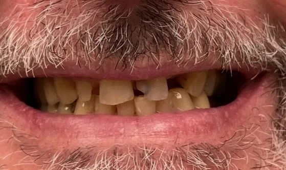 1smilebefore