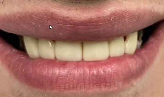 2smileafter