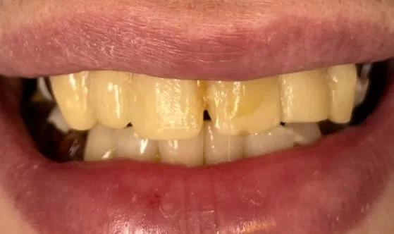2smilebefore