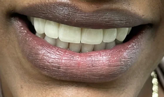 3smileafter