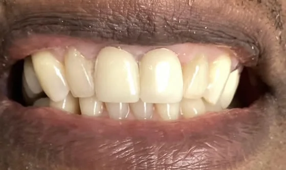 4smileafter