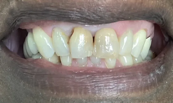 4smilebefore