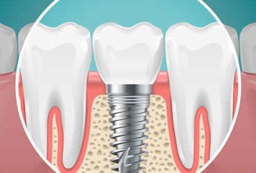 Single Tooth Dental Implant